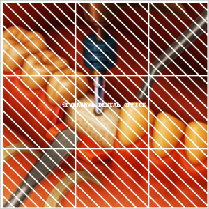 インプラント窩形成時のドリルとバキューム、器具の位置関係を示すイラスト