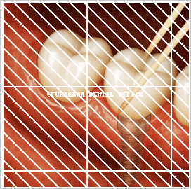 インプラント大臼歯部にスーパーフロスを深く挿入して清掃しているイラスト