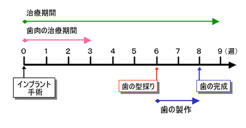 インプラントの治療期間