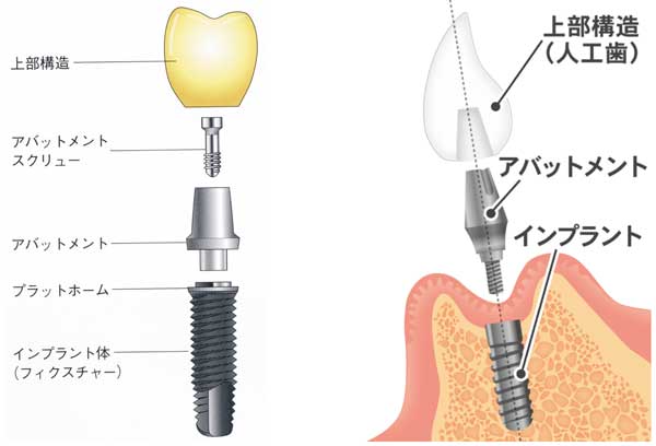 インプラントのパーツ