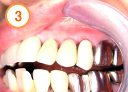 抜歯即時埋入法写真3