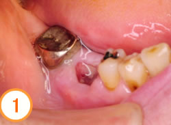 抜歯待時埋入法写真