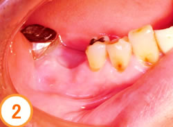 抜歯待時埋入法写真