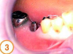 抜歯待時埋入法写真