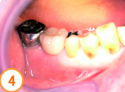 抜歯待時埋入法写真