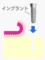 1回法インプラント図