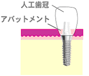 1回法インプラント図