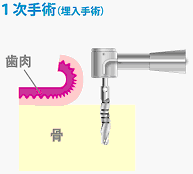 2回法インプラント図