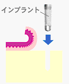 2回法インプラント図
