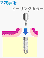 2回法インプラント図