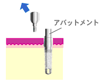 2回法インプラント図