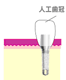 2回法インプラント図