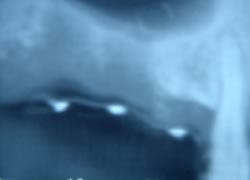 ソッケトリフト例